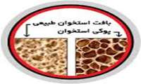 مصرف کورتون زیاد، فرد را مستعد پوکی استخوان می کند.